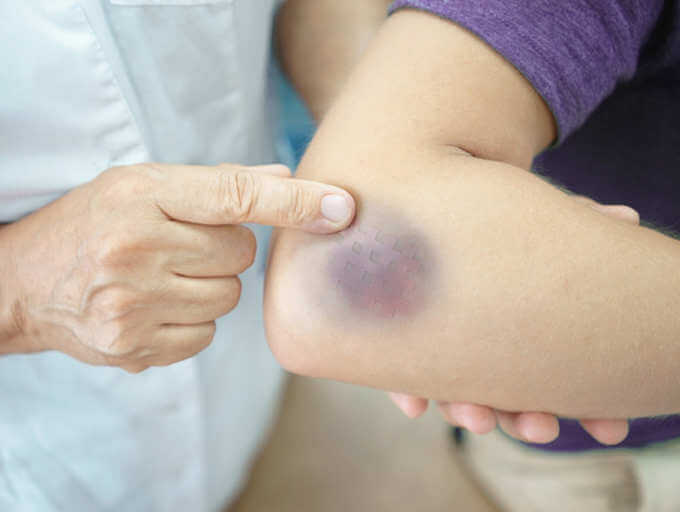 Hematoma vs Bruise | Treatment, Causes, Symptoms
