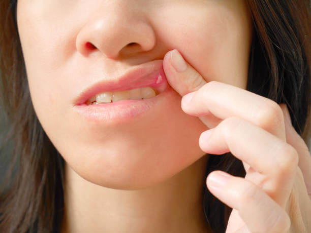 Blister On Lip Causes Symptoms Treatment Angleton Emergency Room 