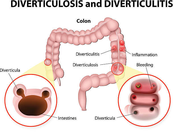 Diverticulosis & Diverticulitis: Symptoms, Treatments, Prevention