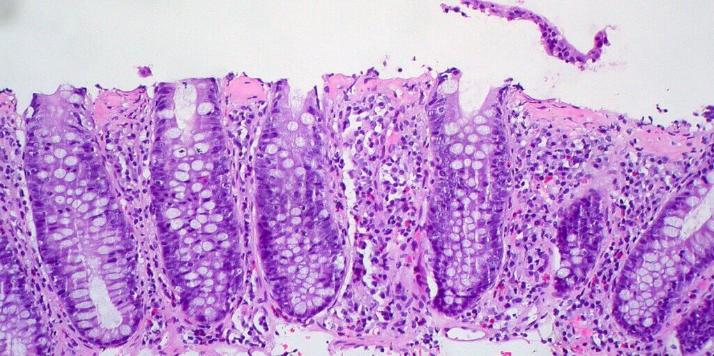 Collagenous Colitis: Symptoms and Treatment 5 Collagenous Colitis