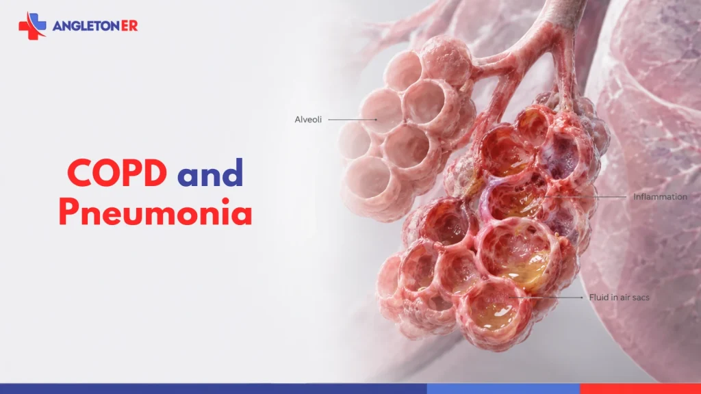 COPD and pneumonia illustration showing inflamed alveoli and fluid buildup in the lung air sacs.