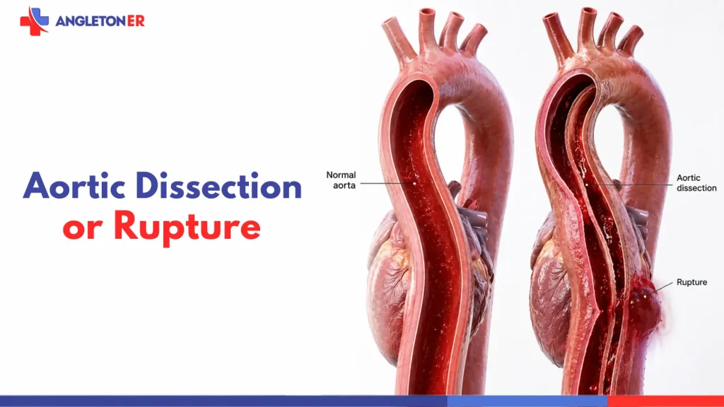 Normal aorta compared with aortic dissection and rupture for an article about sudden warning signs that require emergency care.